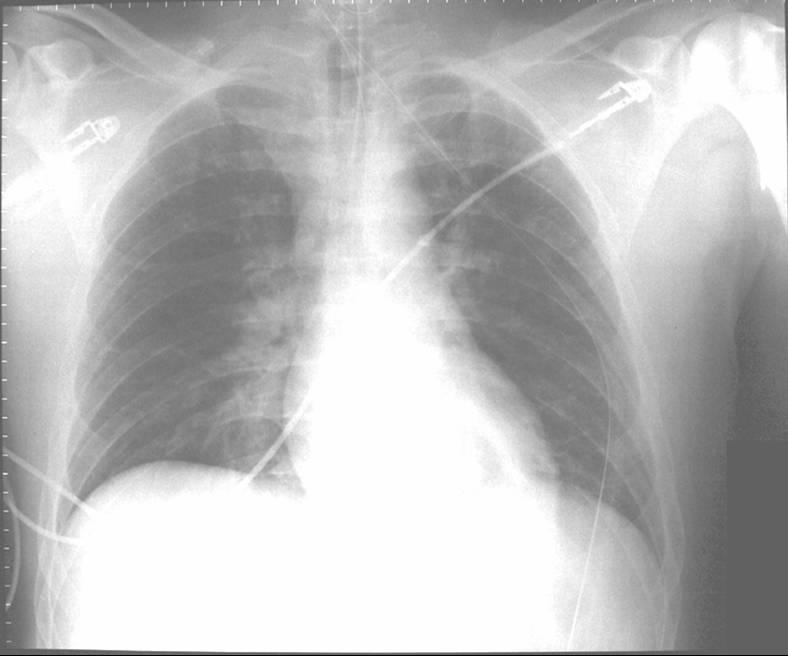 care burn j rehabil American Case Society Thoracic  Study