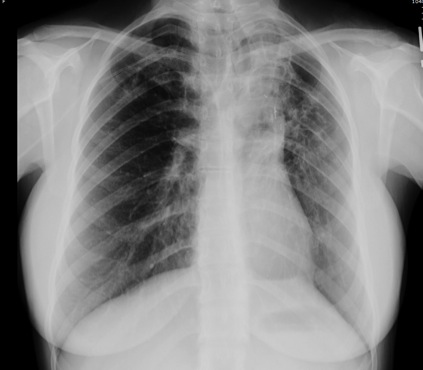 Clinical Considerations for Individuals with Cystic Fibrosis